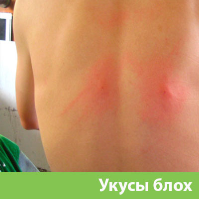 Укусы блох в Нижнем Тагиле