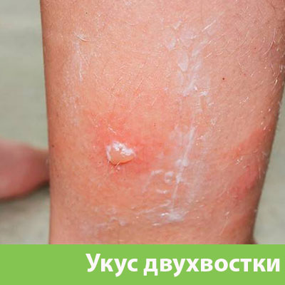 Укус двухвостки в Нижнем Тагиле