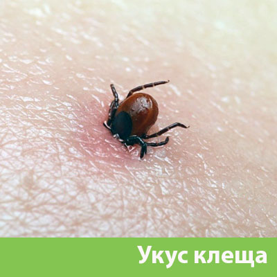 Укус клеща в Нижнем Тагиле