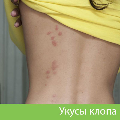 Профессиональное уничтожение клопов в Нижнем Тагиле